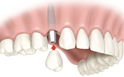 Implantes dentales en Getafe y Móstoles. Clínica Dental de la Dra. Cuadrado