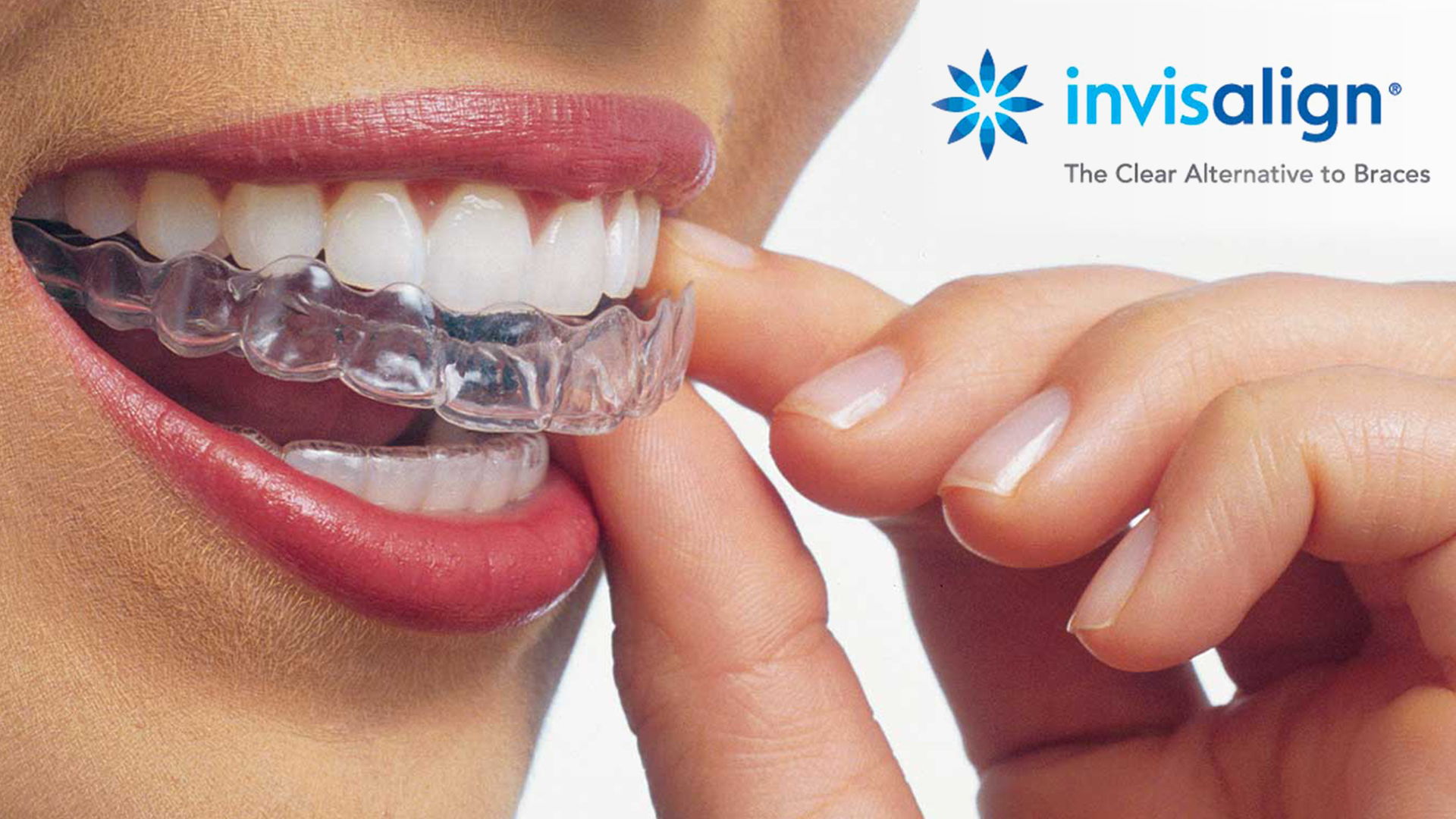 Consigue tu Ortodoncia Invisalign al mejor precio con nuestra Promoción de Febrero