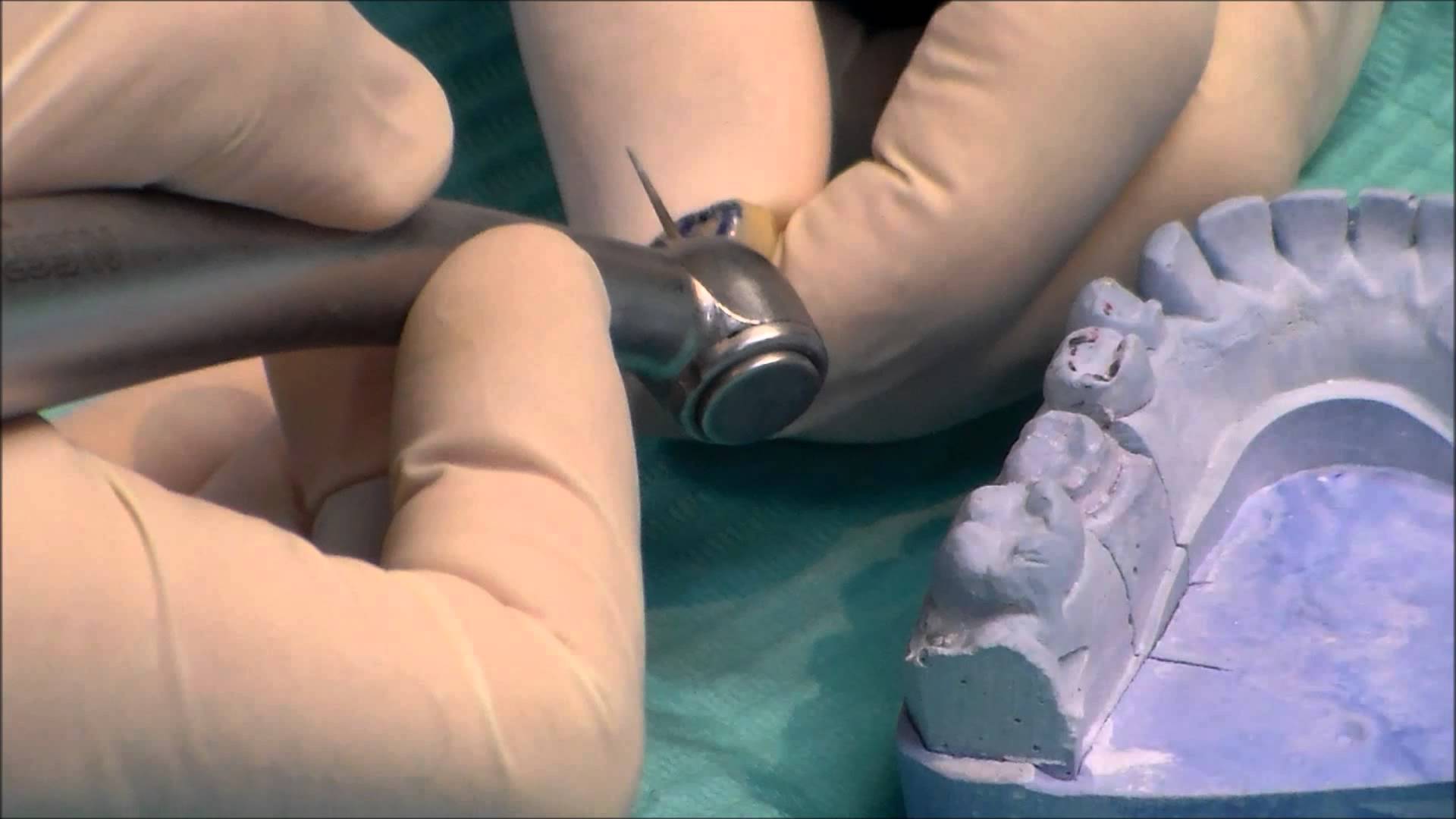 En la Clínica Dental Cuadrado encontrará las mejores Coronas y Puentes dentales