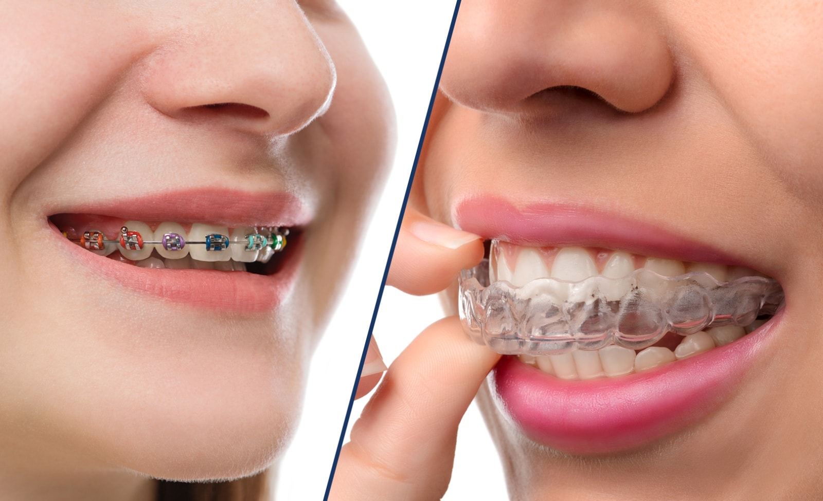 Disfruta de Invisalign y sus múltiples ventajas