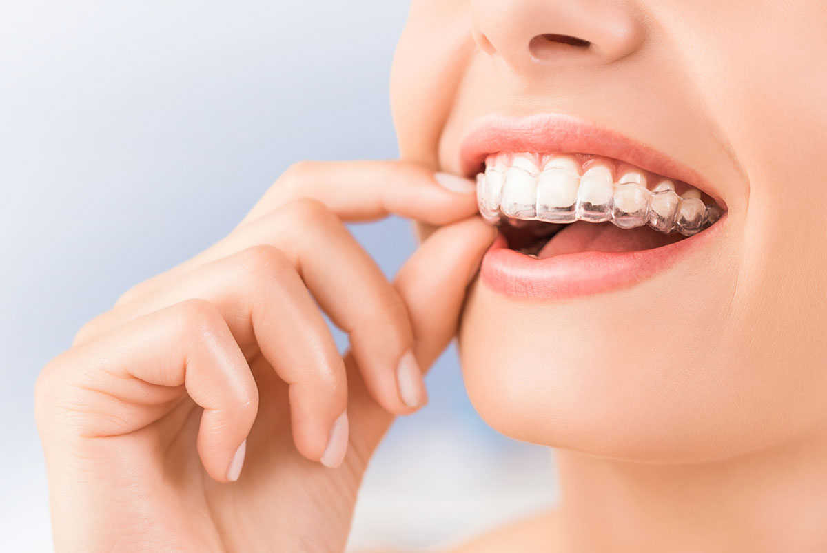 Clínica Dental Cuadrado: Invisalign Provider oficial en Getafe y Móstoles