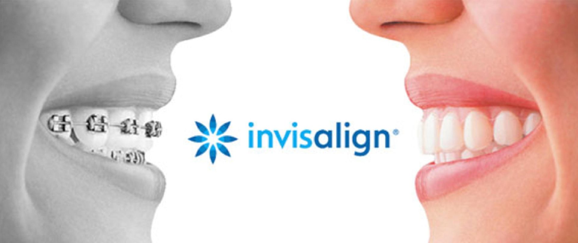 Más preguntas y respuestas sobre el sistema Invisalign