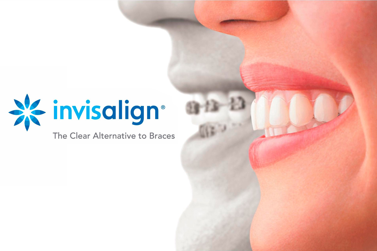 Este mes de Julio consigue tu ortodoncia Invisalign al mejor precio con la Clínica Dental Cuadrado