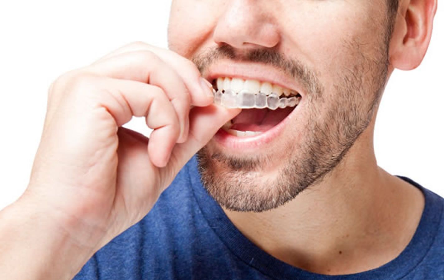 ¿Aún no conoces la ortodoncia Invisalign? Descúbrela con la Clínica Dental Cuadrado