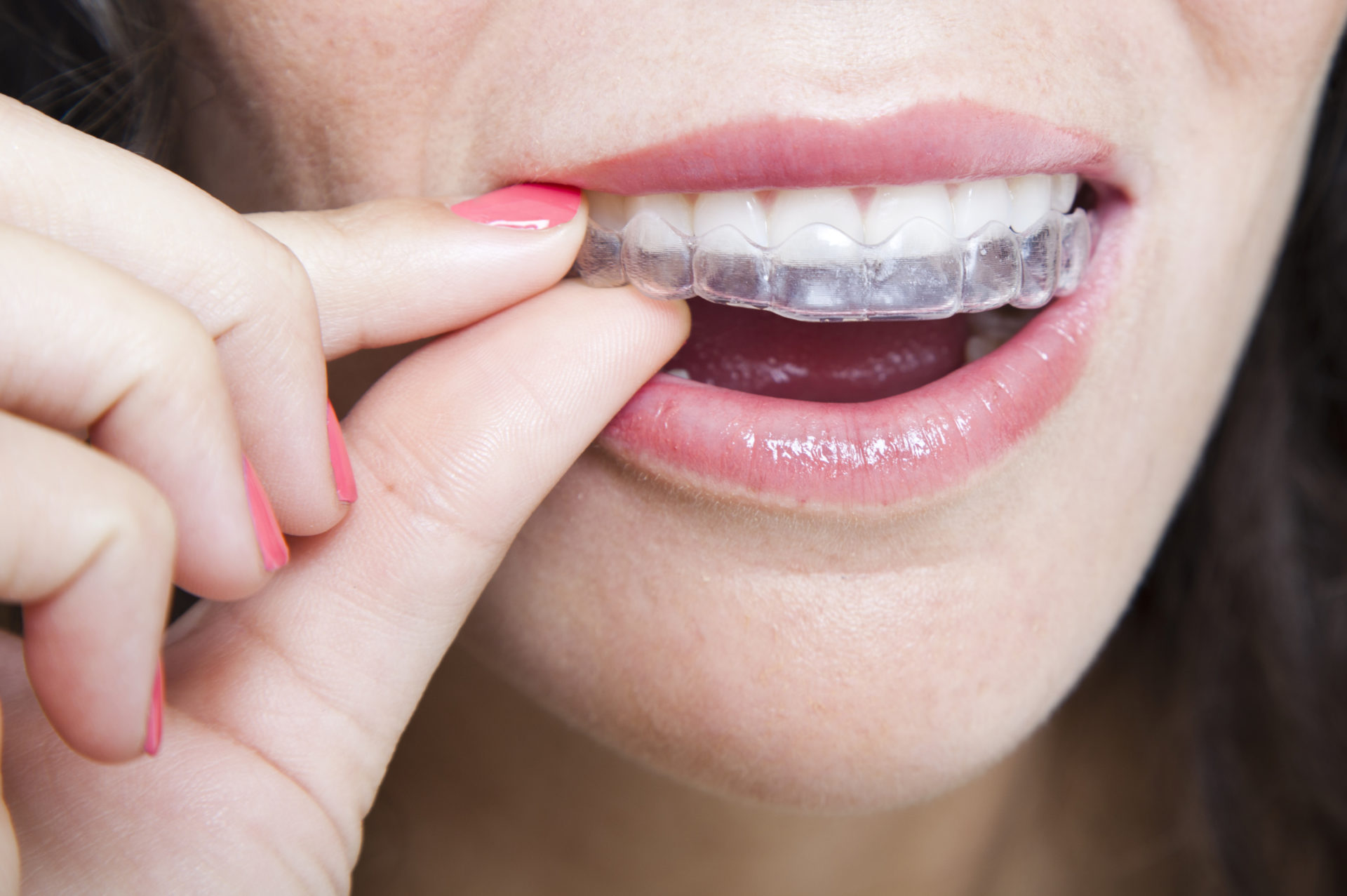 Durante este mes de septiembre también puedes conseguir tu ortodoncia Invisalign al mejor precio en la Clínica Dental Cuadrado