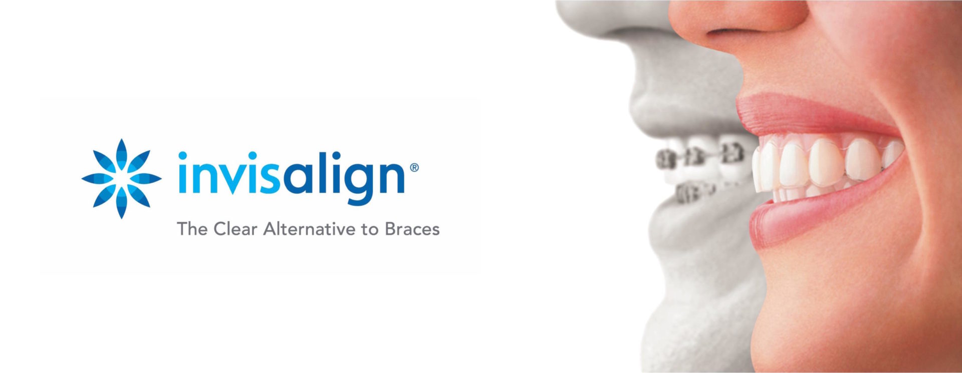 Invisalign, la ortodoncia invisible que eligen cada vez más pacientes