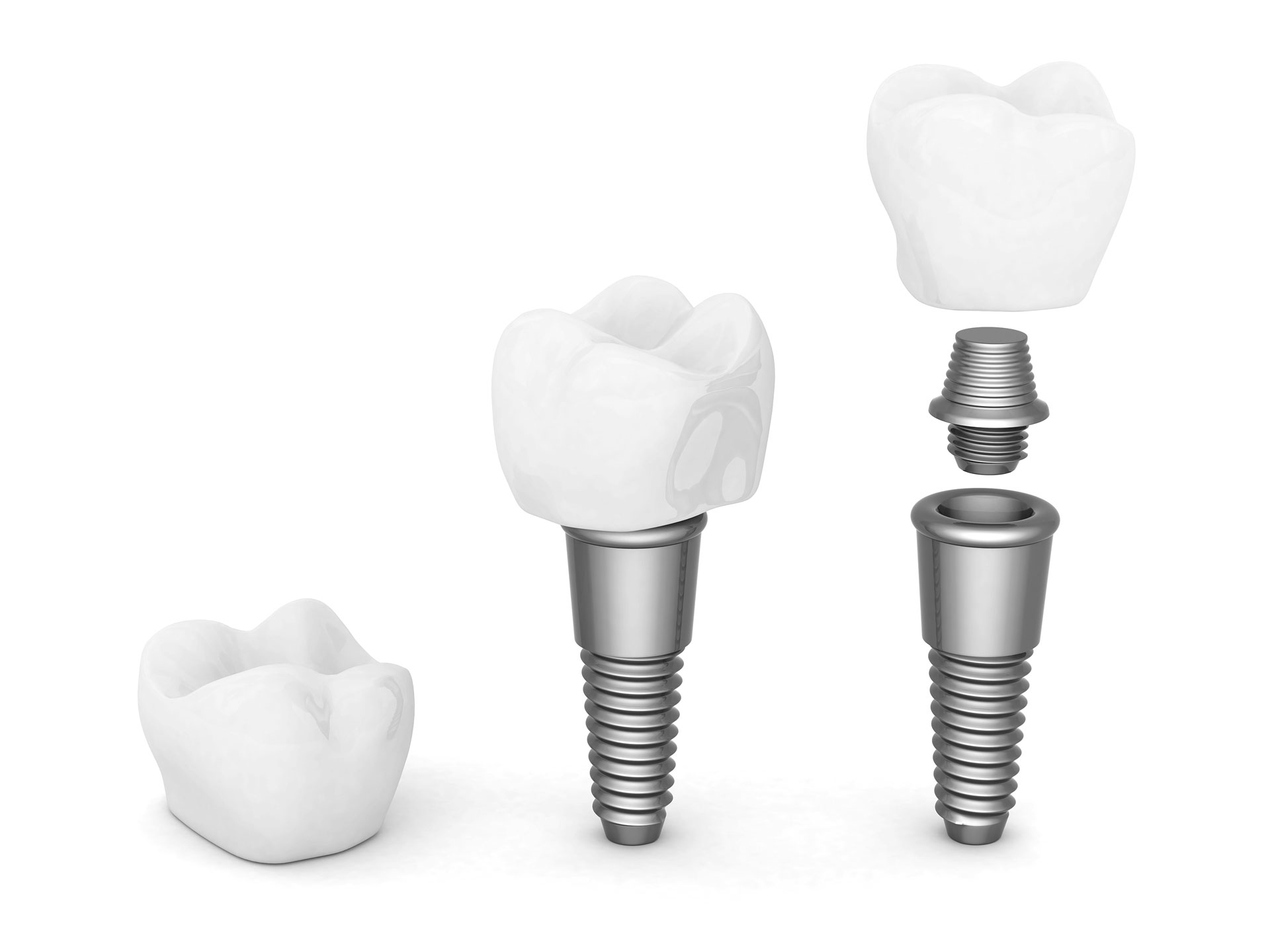 Más ventajas del uso de los implantes dentales