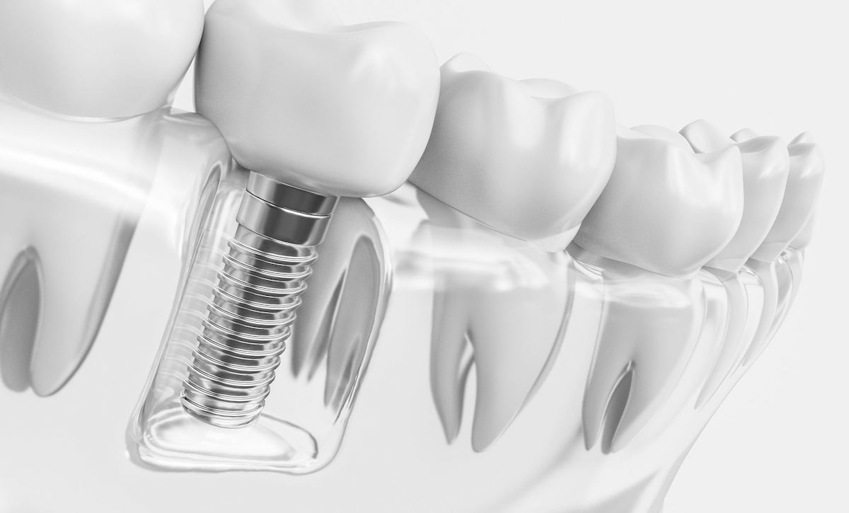 Descubre las principales ventajas que presentan los implantes dentales