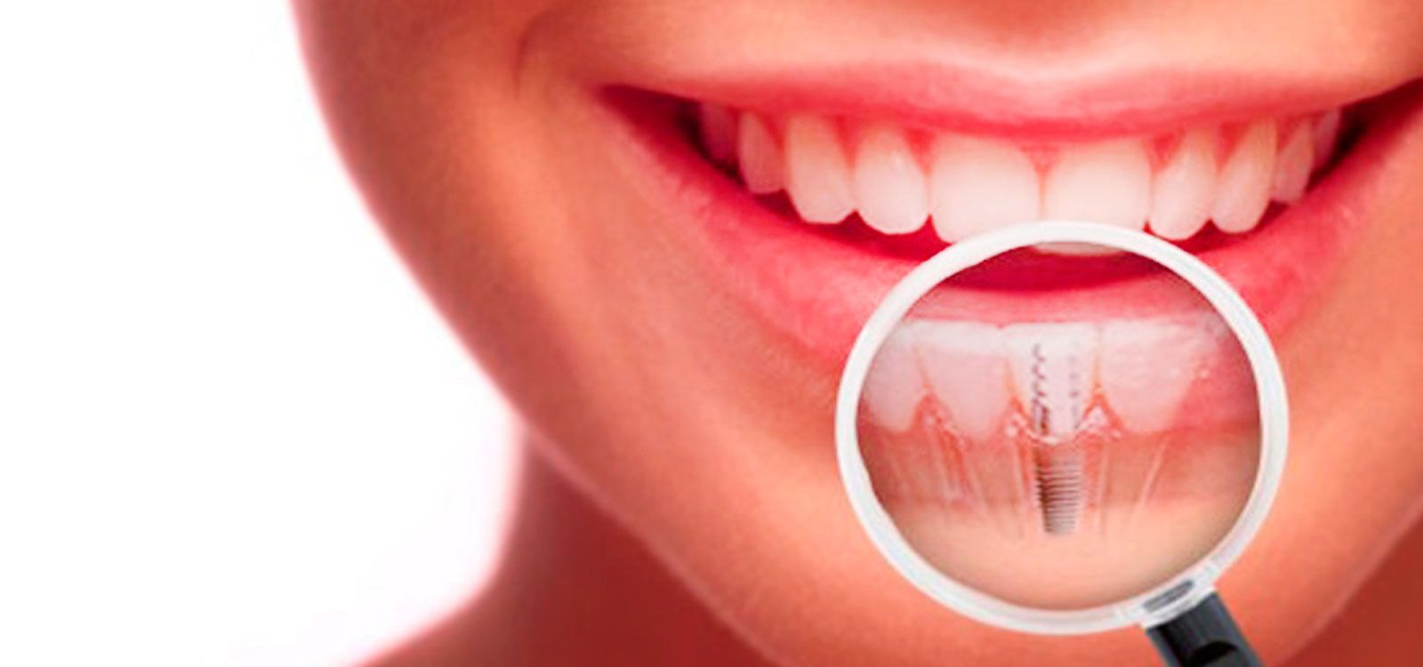 Los implantes dentales son fundamentales para evitar problemas de salud