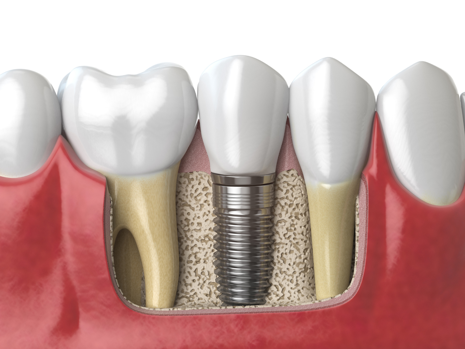 Implantes dentales…un tratamiento lleno de ventajas y beneficios