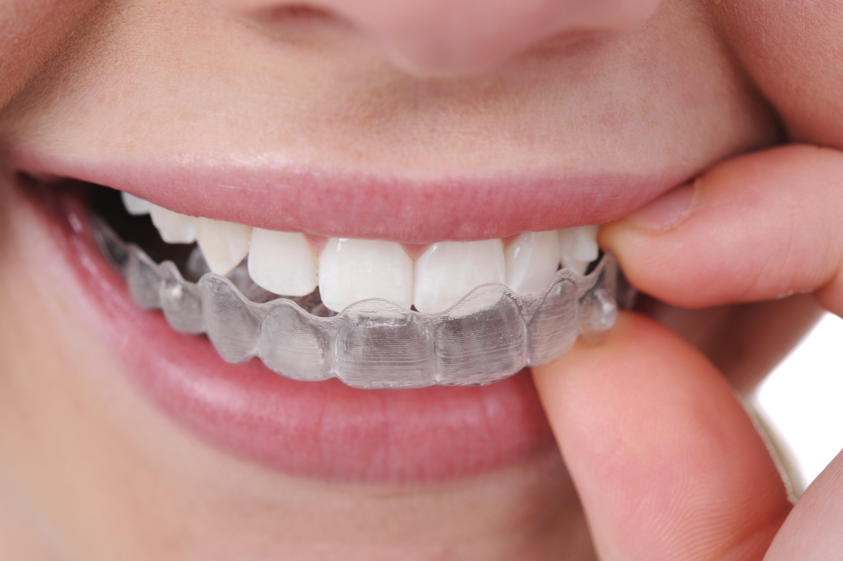 Alinea tus dientes con Invisalign, ¡todo son ventajas!