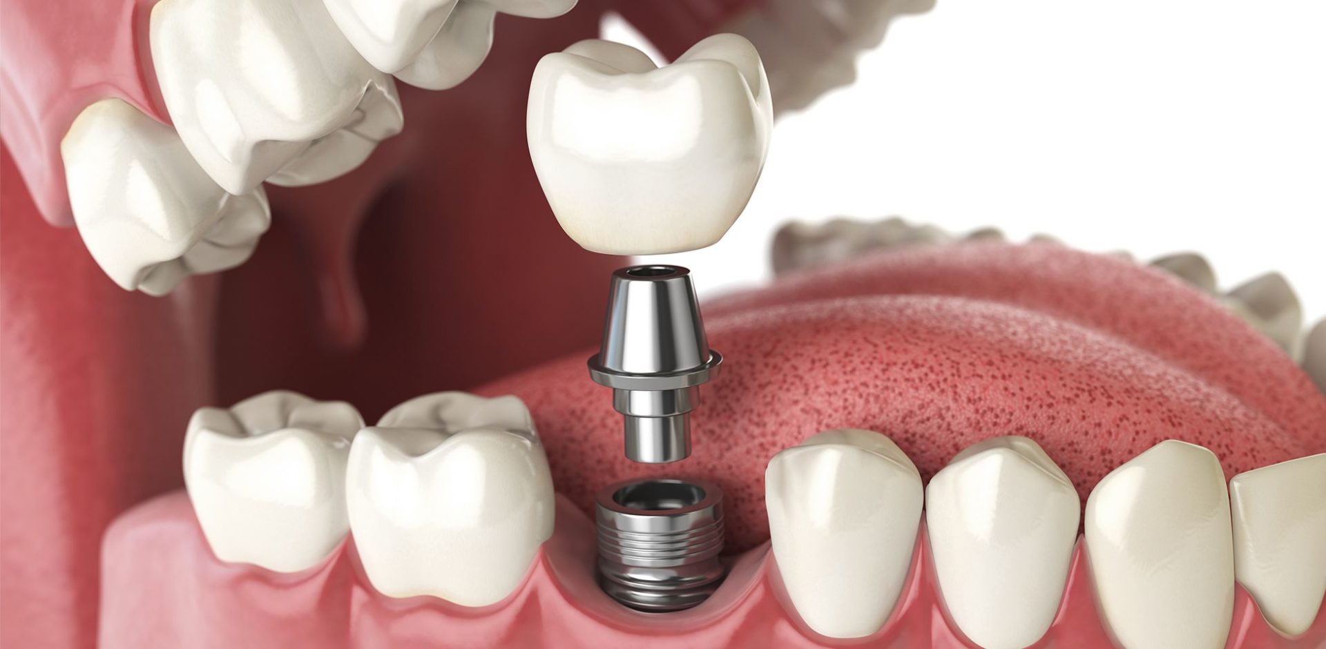 Implantes dentales, una solución de larga duración para mejorar tu salud