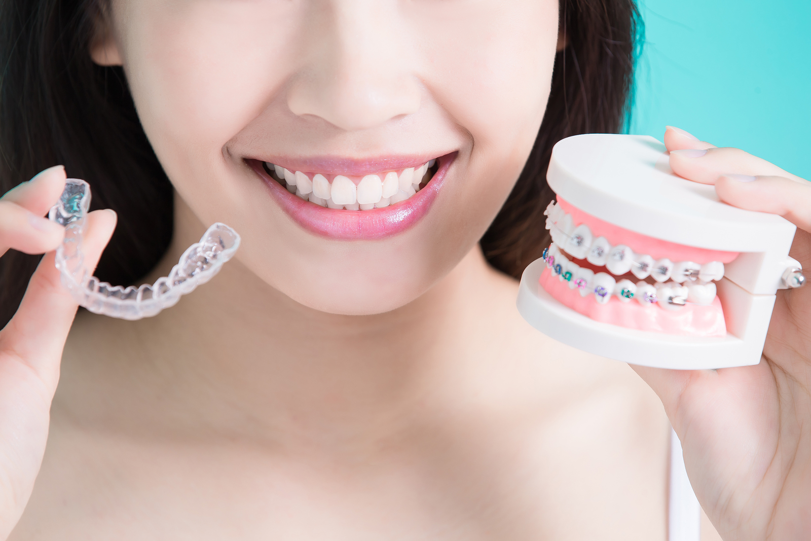 Comparando los brackets y los alineadores transparentes de Invisalign