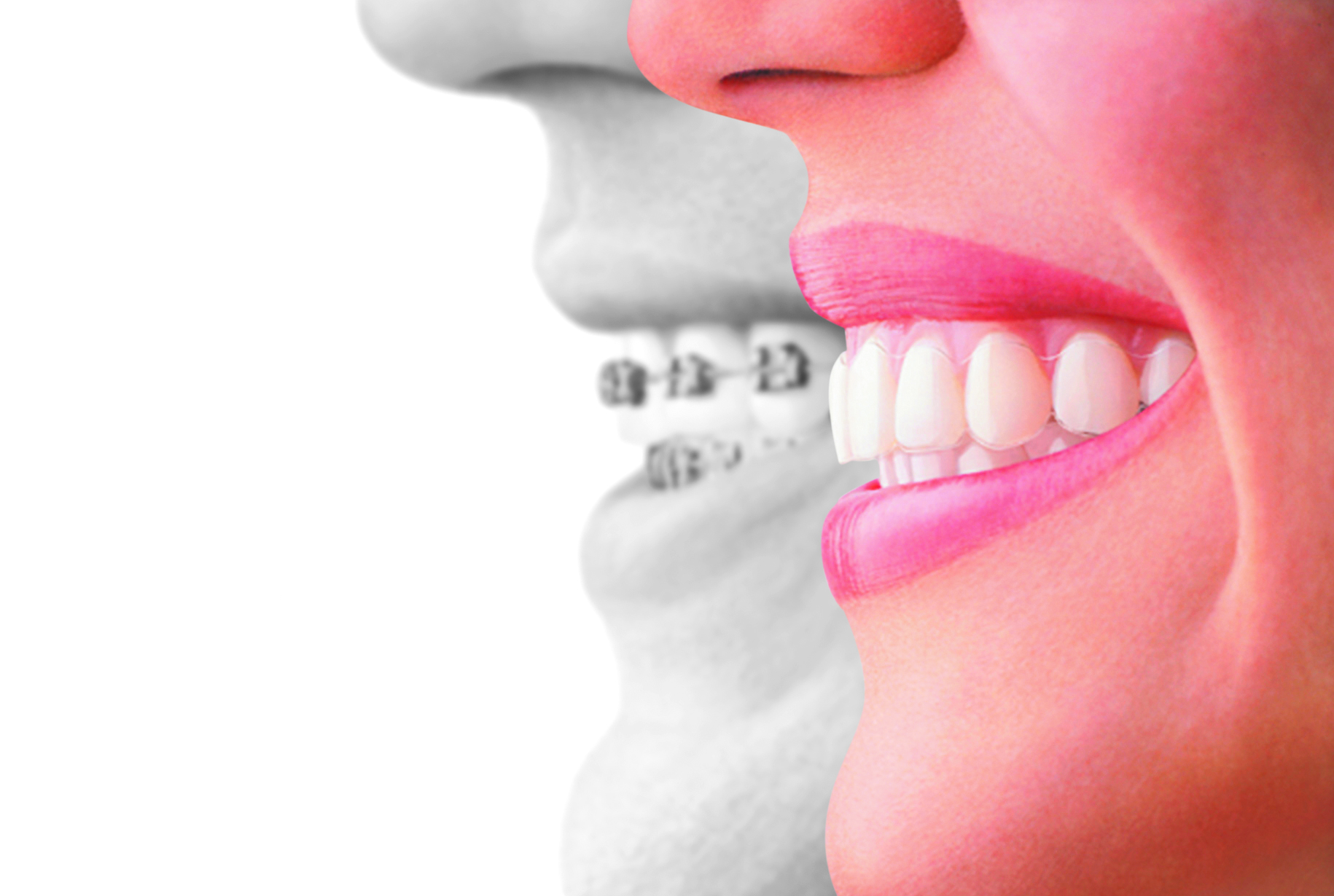 ¿Invisalign o Brackets? ¿Qué ortodoncia debo elegir?