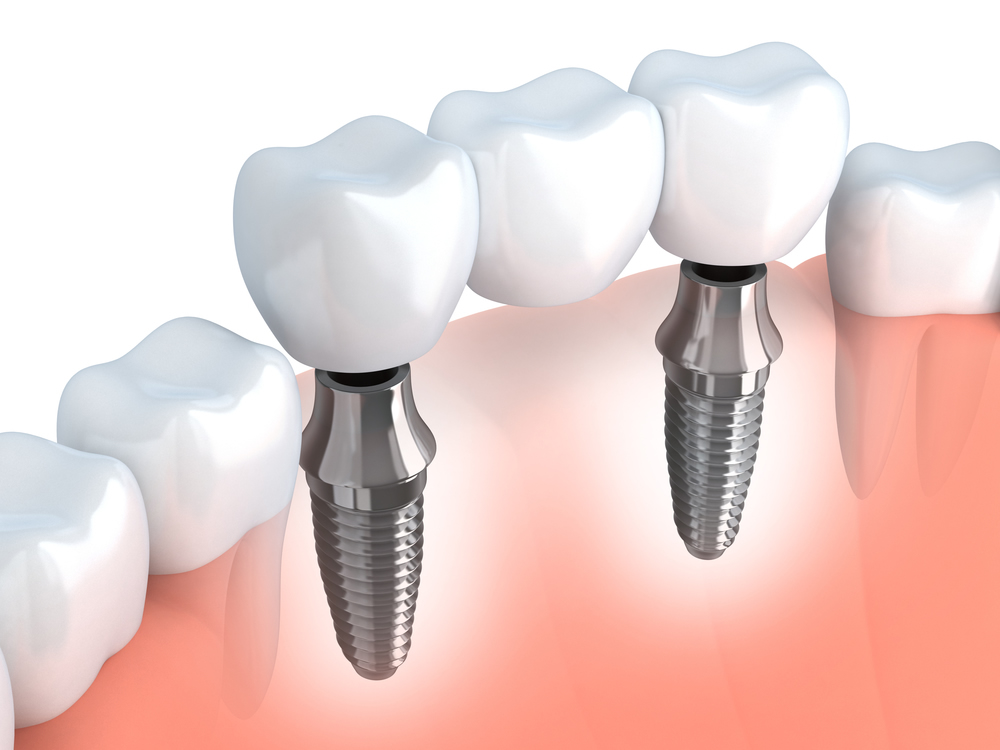 Conoce un poco mejor la cirugía de implante dental