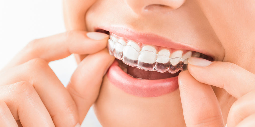 ¿Dudas sobre Invisalign? ¡En Clínica Dental Cuadrado te las aclaramos todas!