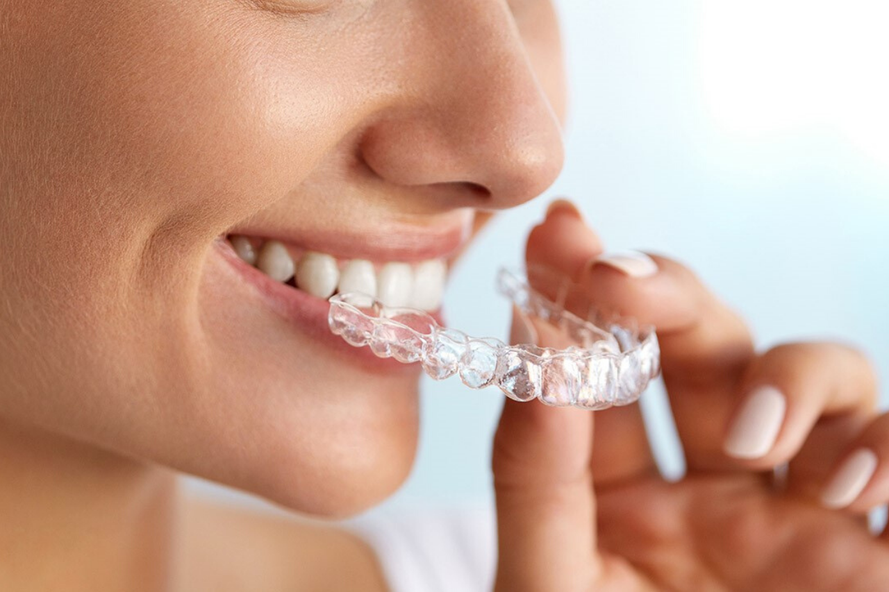 ¿Cómo funciona la tecnología Invisalign? ¡El tratamiento más avanzado para alinear tus dientes!