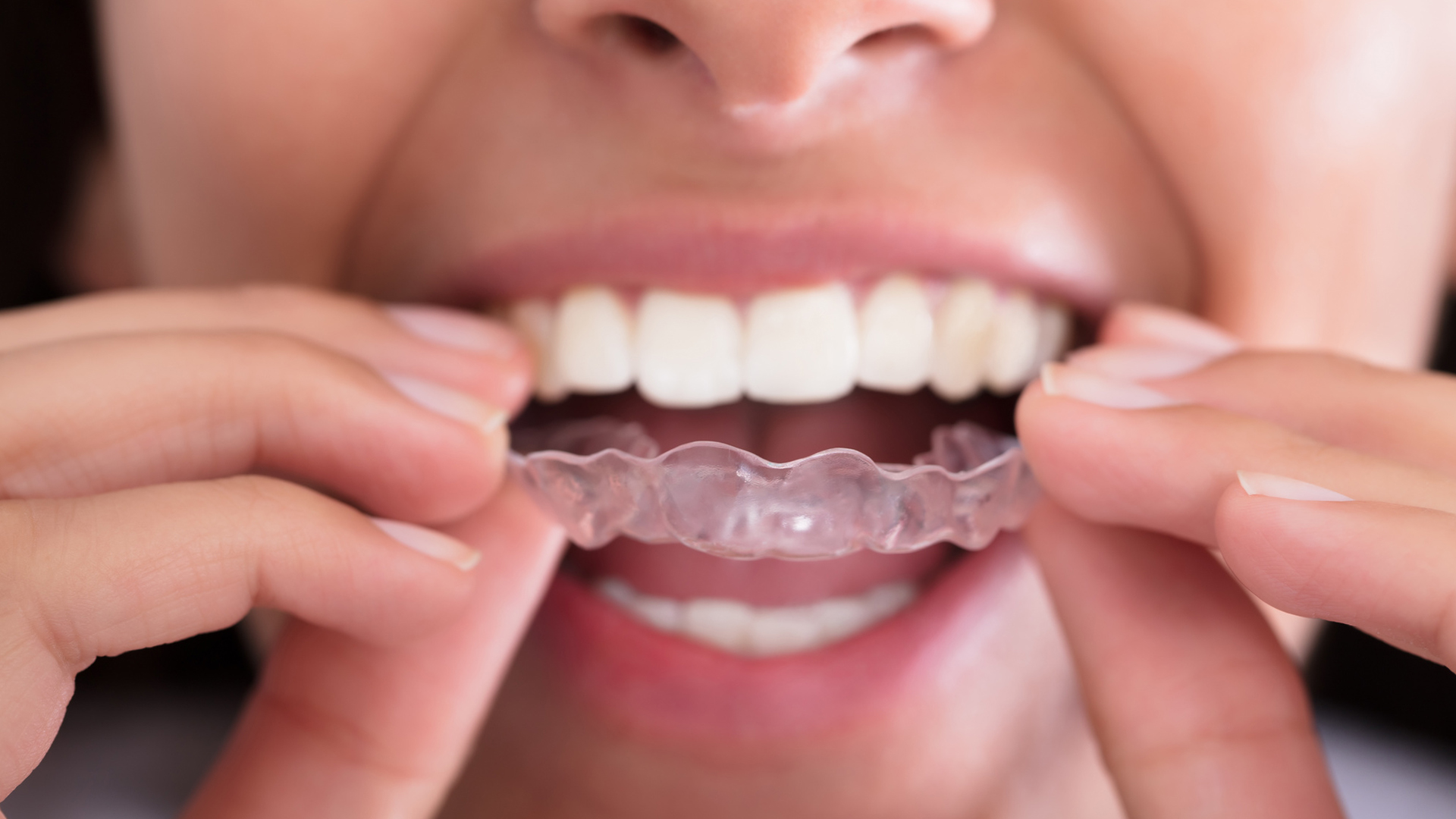 ¿Cuáles son los principales beneficios de Invisalign? En Clínica Dental Cuadrado te lo contamos