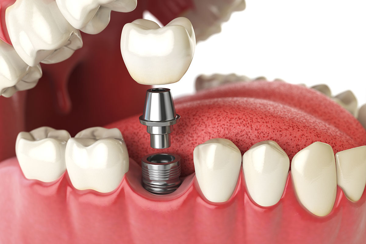 Implantes dentales fijos o removibles, ¿cuáles debemos elegir?