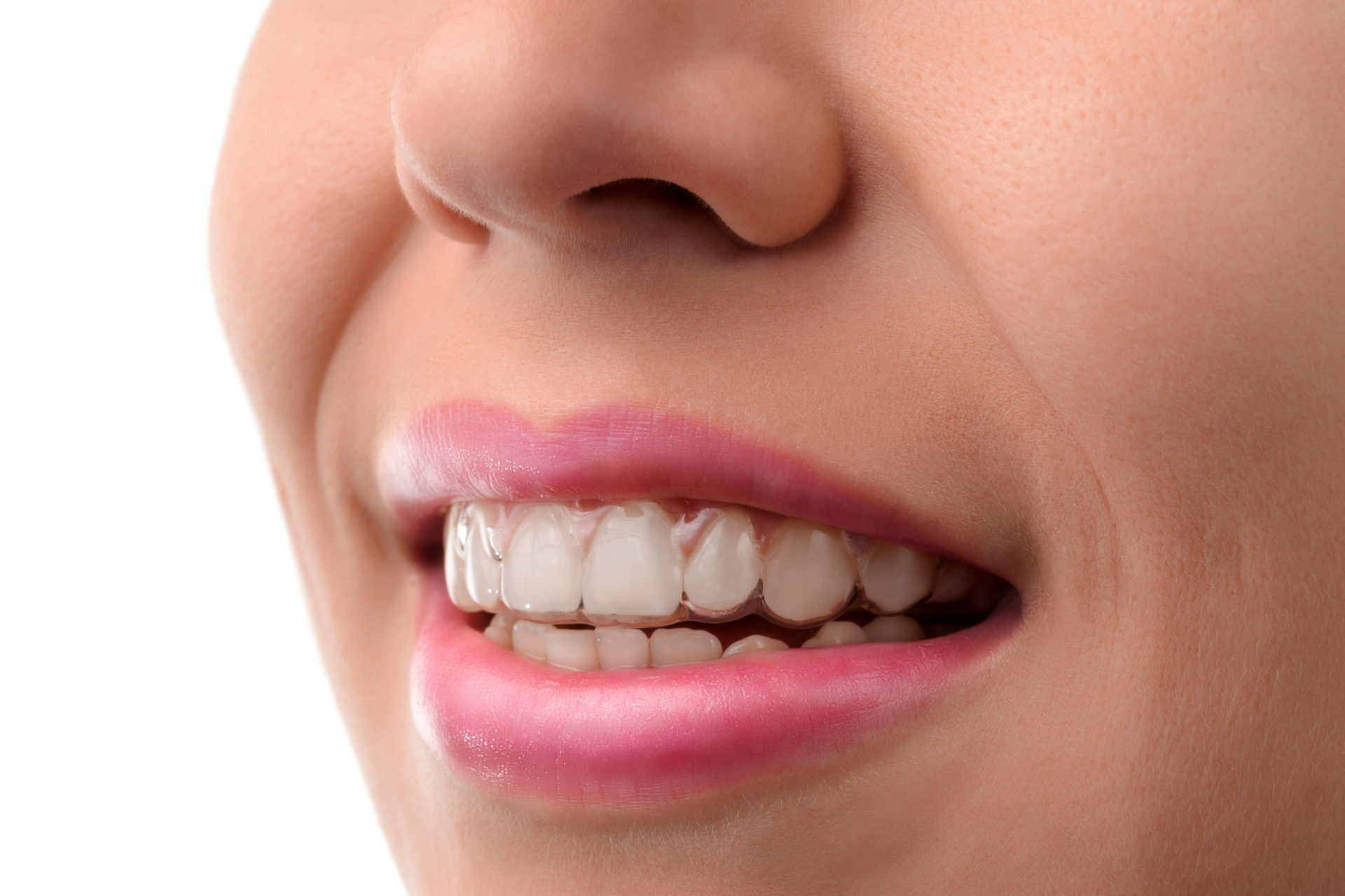 ¿Cómo llevar una ortodoncia para alinear tus dientes y realizar tu vida con total normalidad?