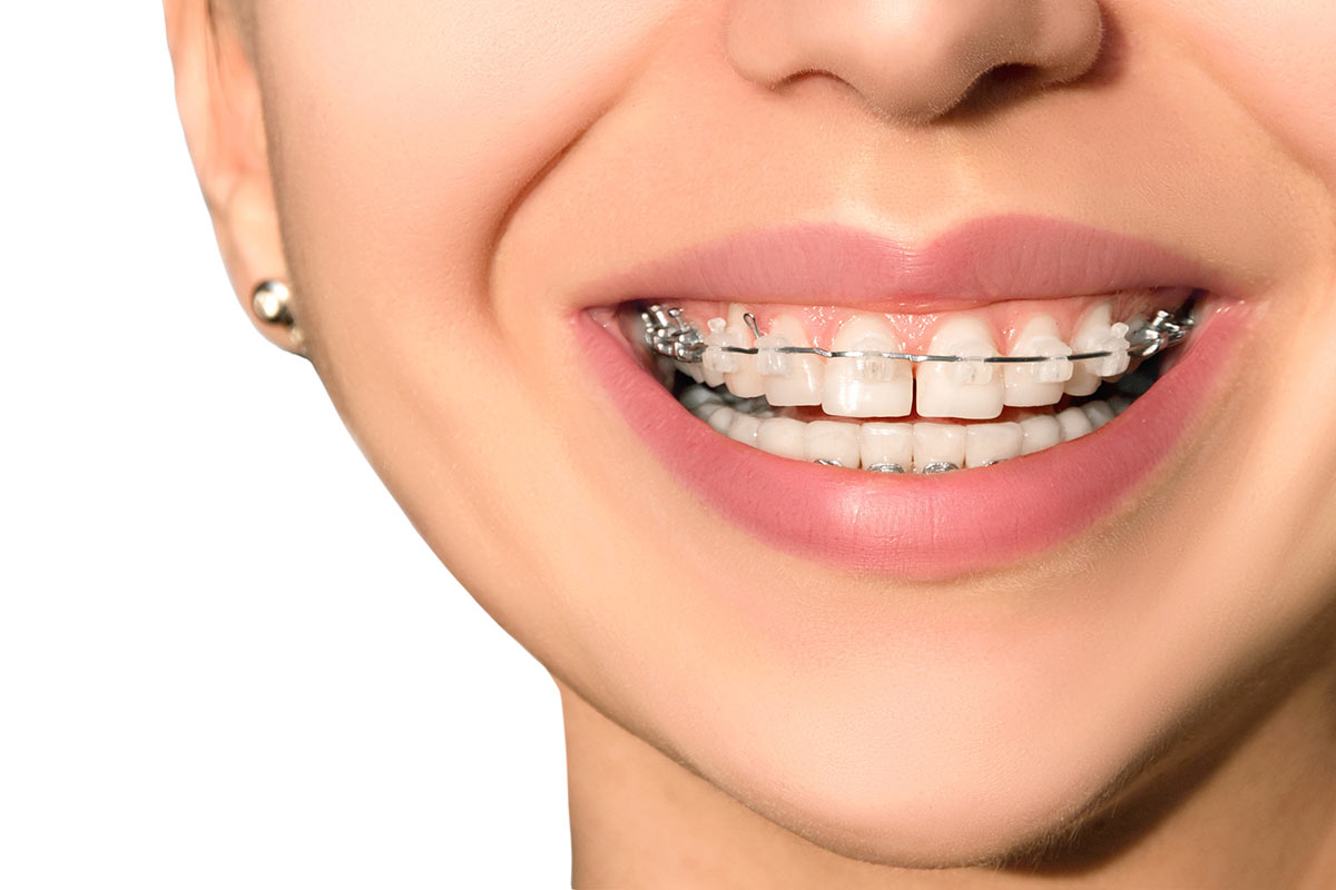¿Qué ventajas le proporciona al paciente llevar una ortodoncia?