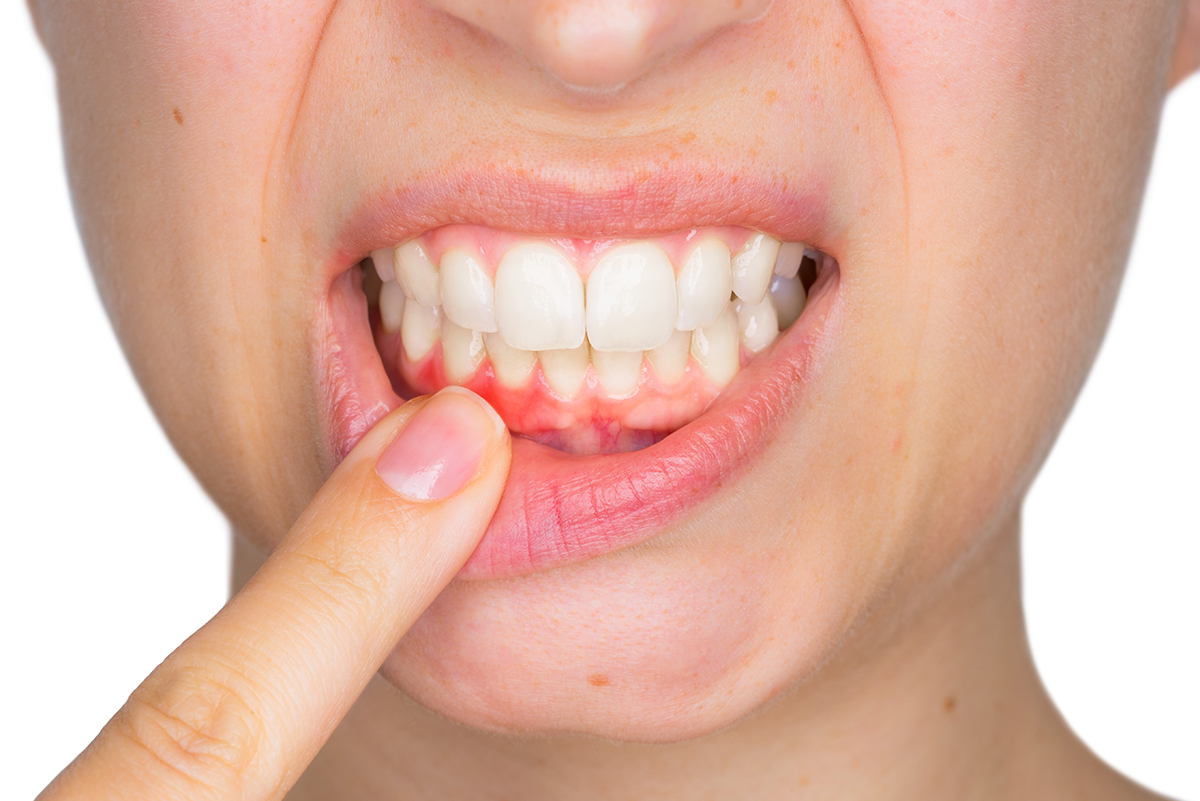 ¿Te sangran las encías? Pásate por Clínica Dental Cuadrado