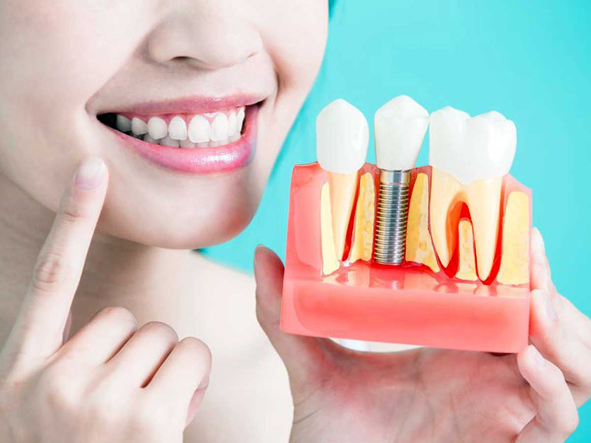 Pon un implante dental en tu vida… ¡no te arrepentirás!