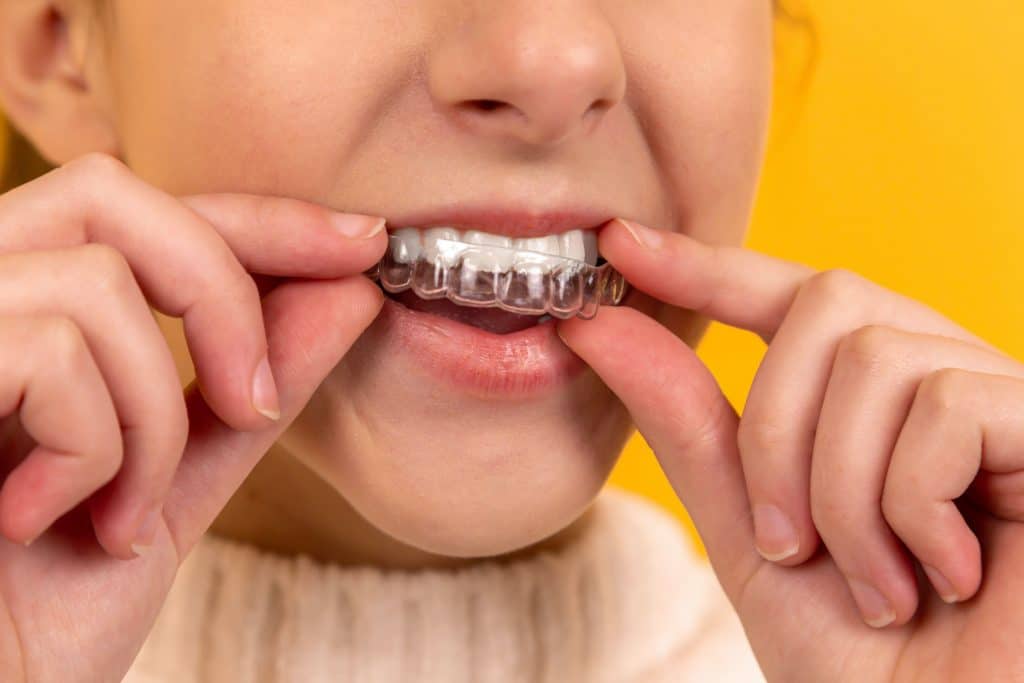 Invisalign Teen, la ortodoncia para jóvenes que marcará tendencia este 2022