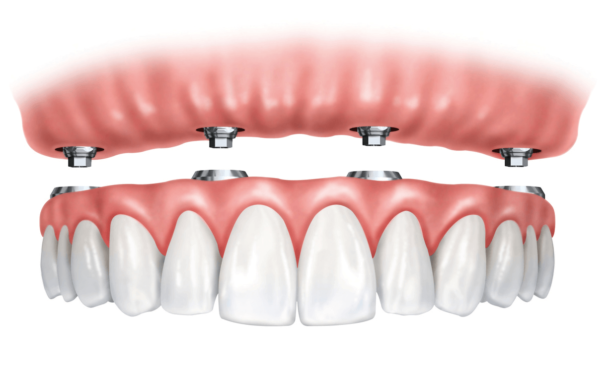 evitar ejemplo Imitación Implantes dentales fijos o extraíbles, ¿qué es mejor? | Clínica Dental  Cuadrado
