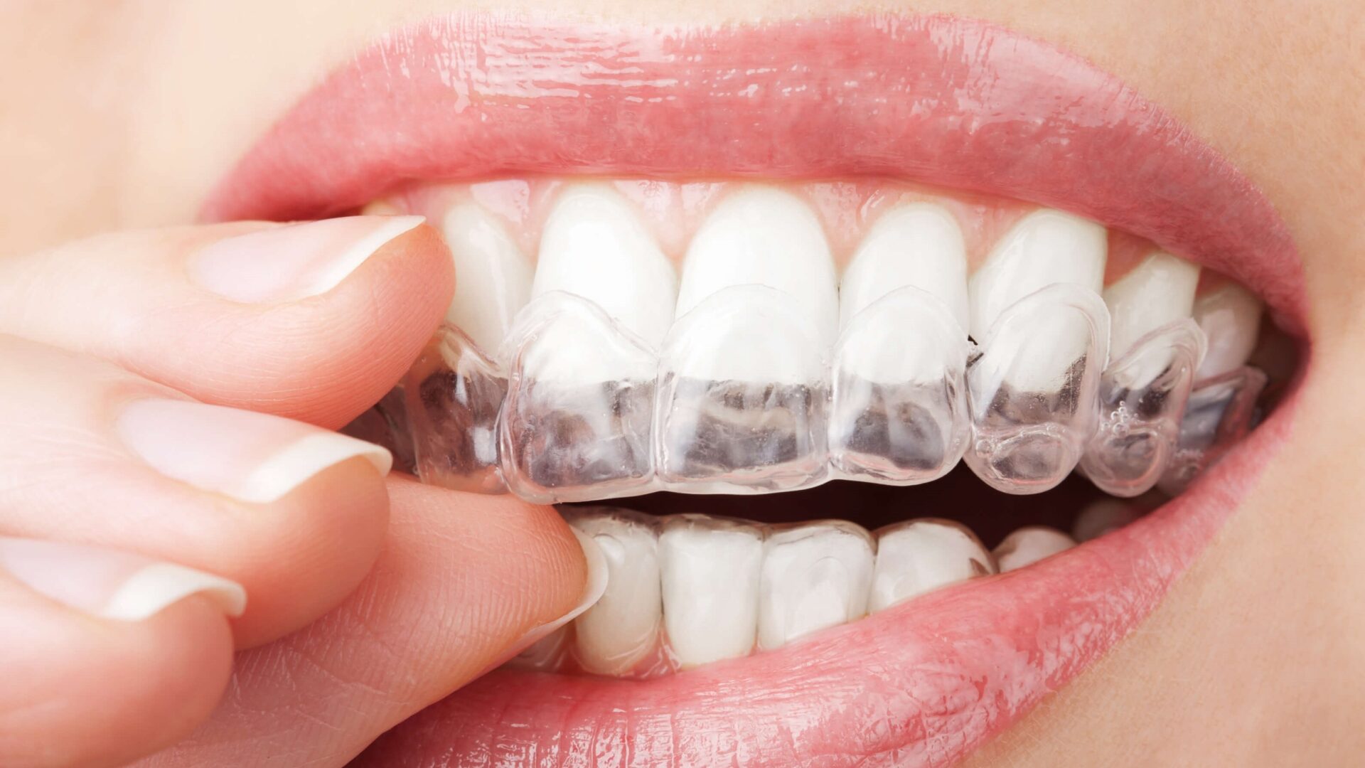 Invisalign, la ortodoncia que mejor te queda