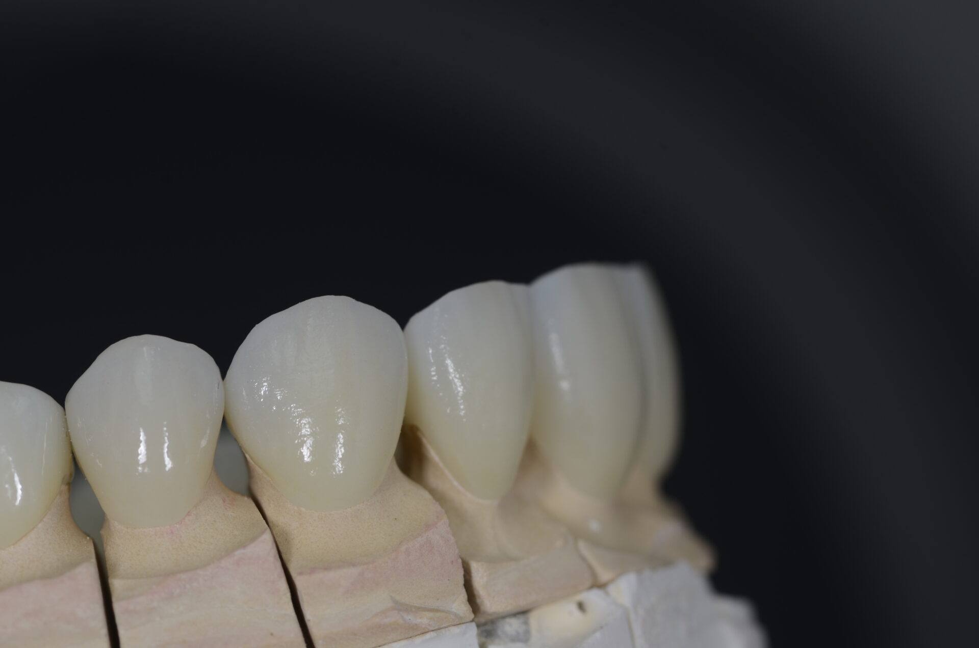 Prótesis dentales de zirconio, un material seguro para toda la vida