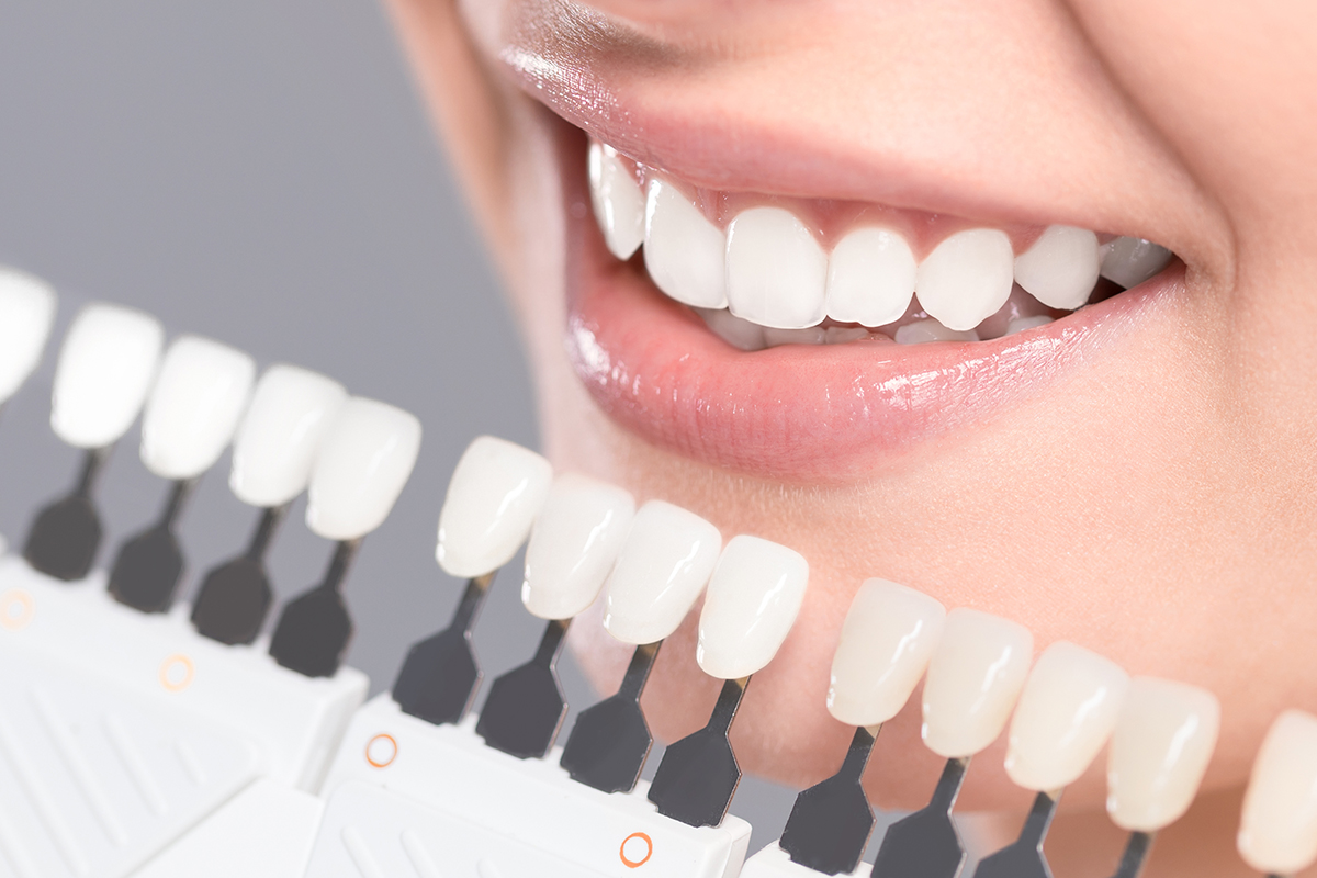 Encuentra el mejor blanqueamiento dental para tus dientes en la Clínica Dental Cuadrado