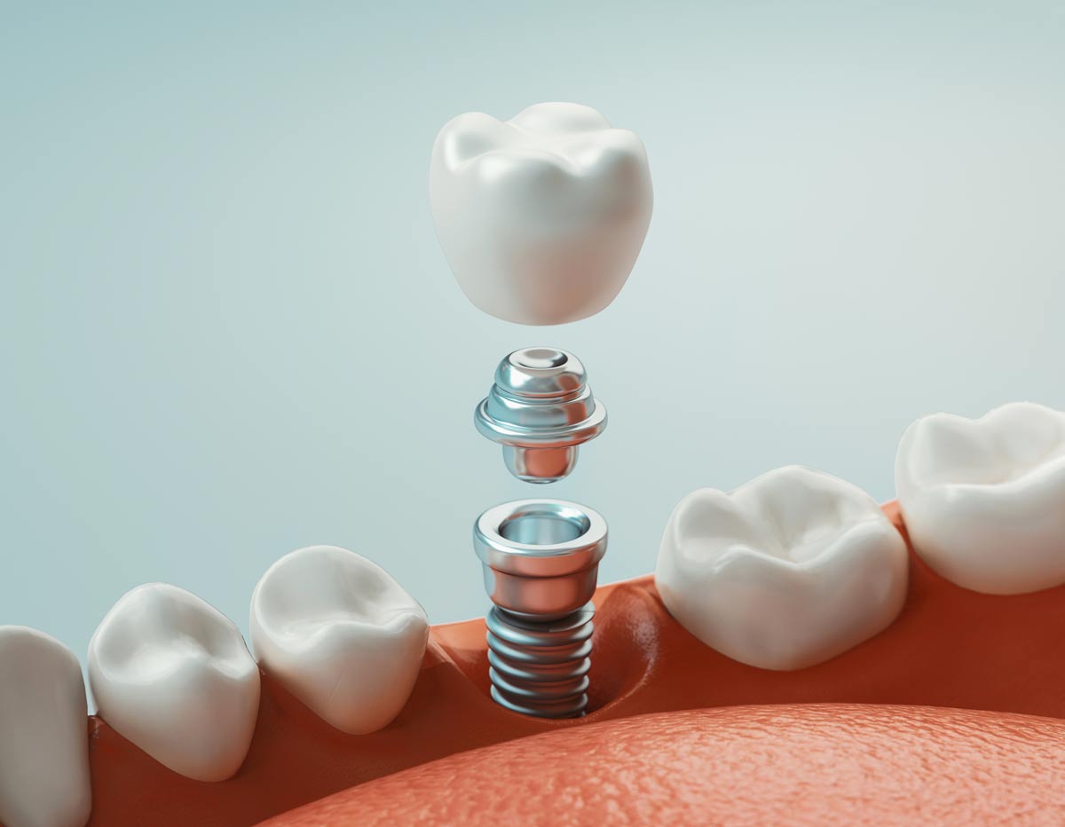 Cirugía de implante dental: una solución a muchos problemas
