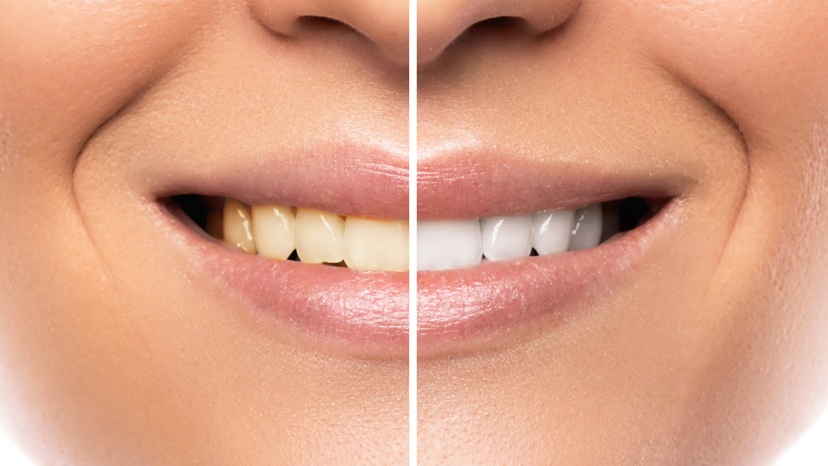 Blanqueamiento dental: un tratamiento seguro para devolver el blanco perdido a tus dientes