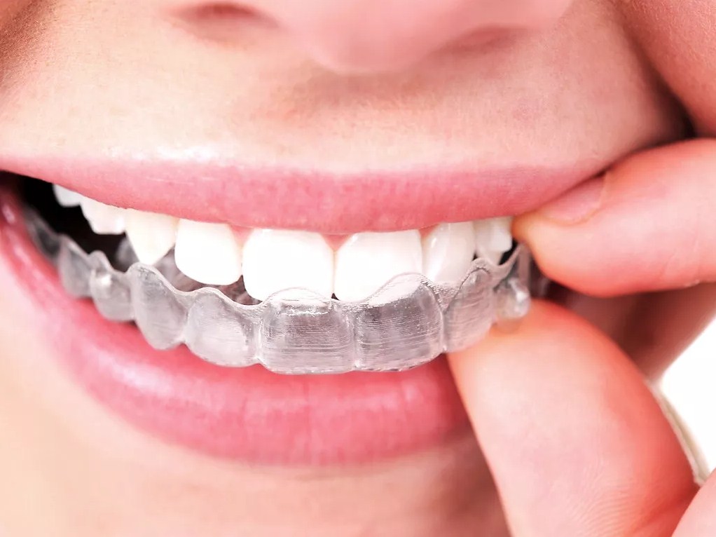 Invisalign, una ortodoncia invisible y sin alambres