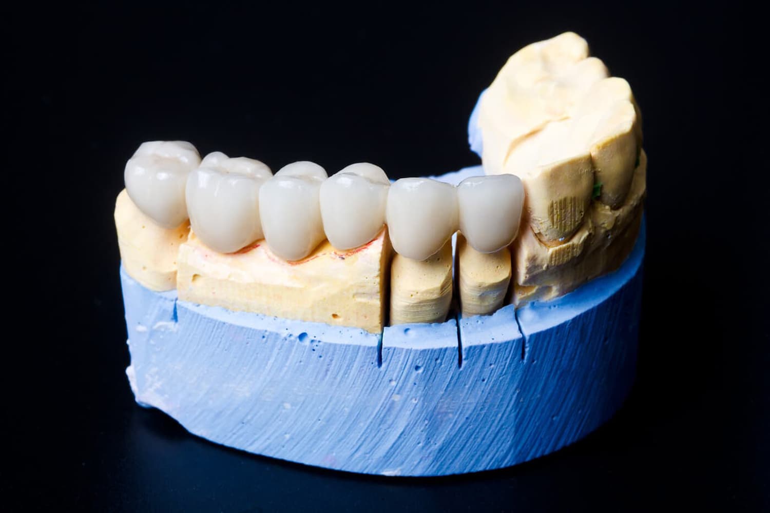 Prótesis dentales de zirconio, una solución eficaz y segura