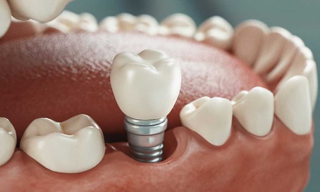 Implantes dentales fijos, una solución habitual y muy eficiente