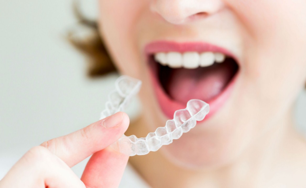 Invisalign, la ortodoncia completamente extraíble que marca la diferencia