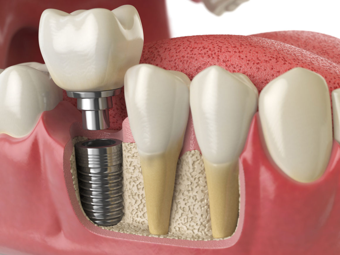 Descubre cómo se realizan los implantes dentales