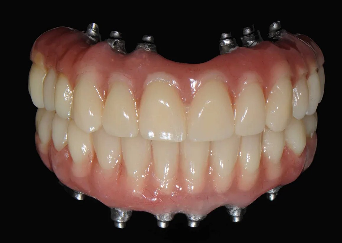 ¿De qué están hechas las prótesis híbridas dentales?