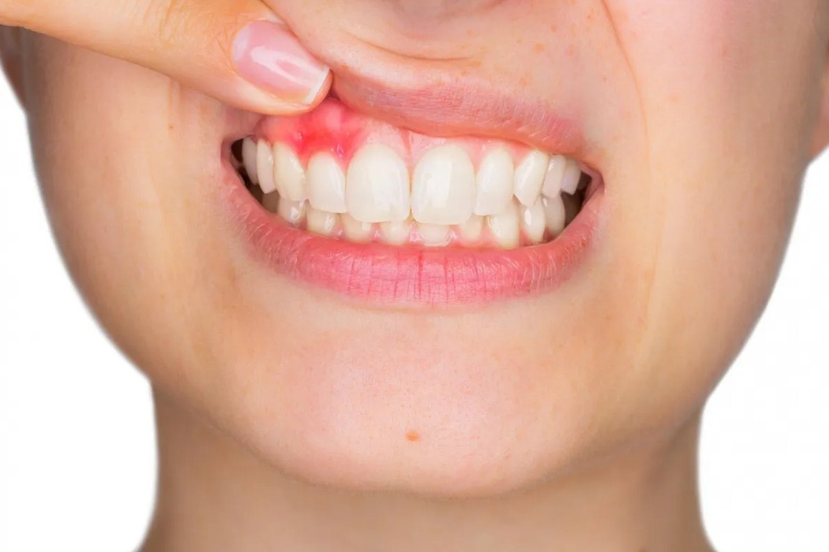 Gingivitis: la enfermedad que te hace sangrar las encías