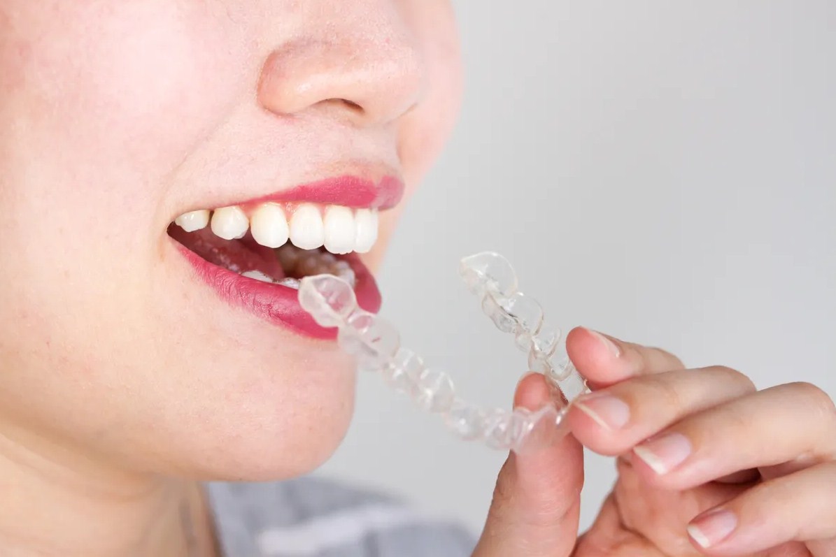 El éxito de la ortodoncia Invisalign es indiscutible