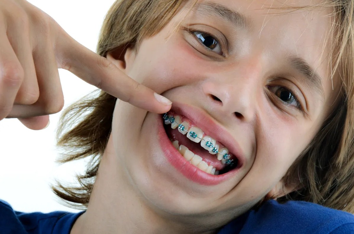 ¿Por qué ponerle una ortodoncia a nuestros hijos pequeños?