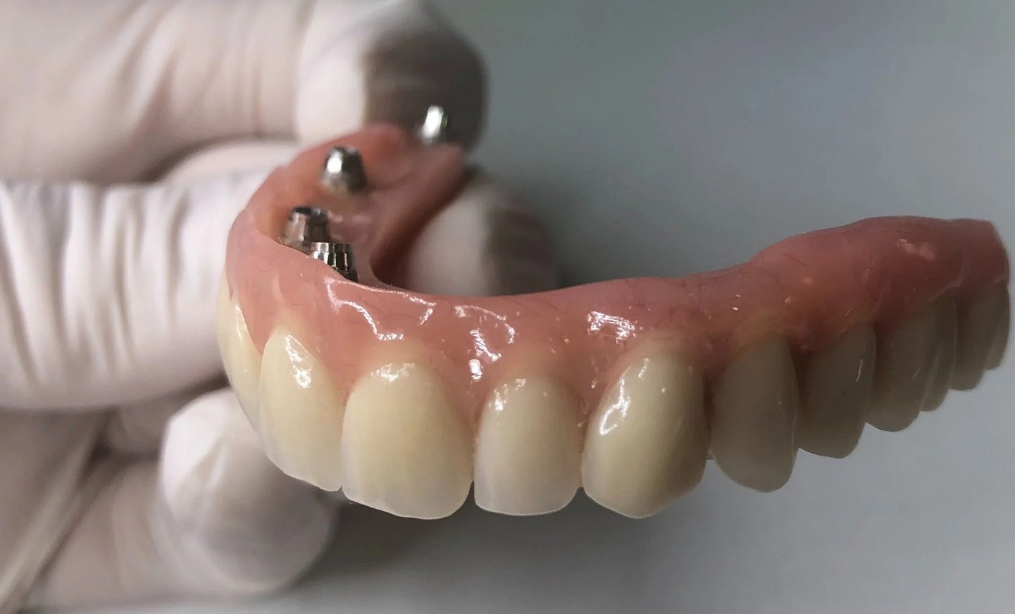 Otros tipos de prótesis híbridas dentales: metal-acrílico
