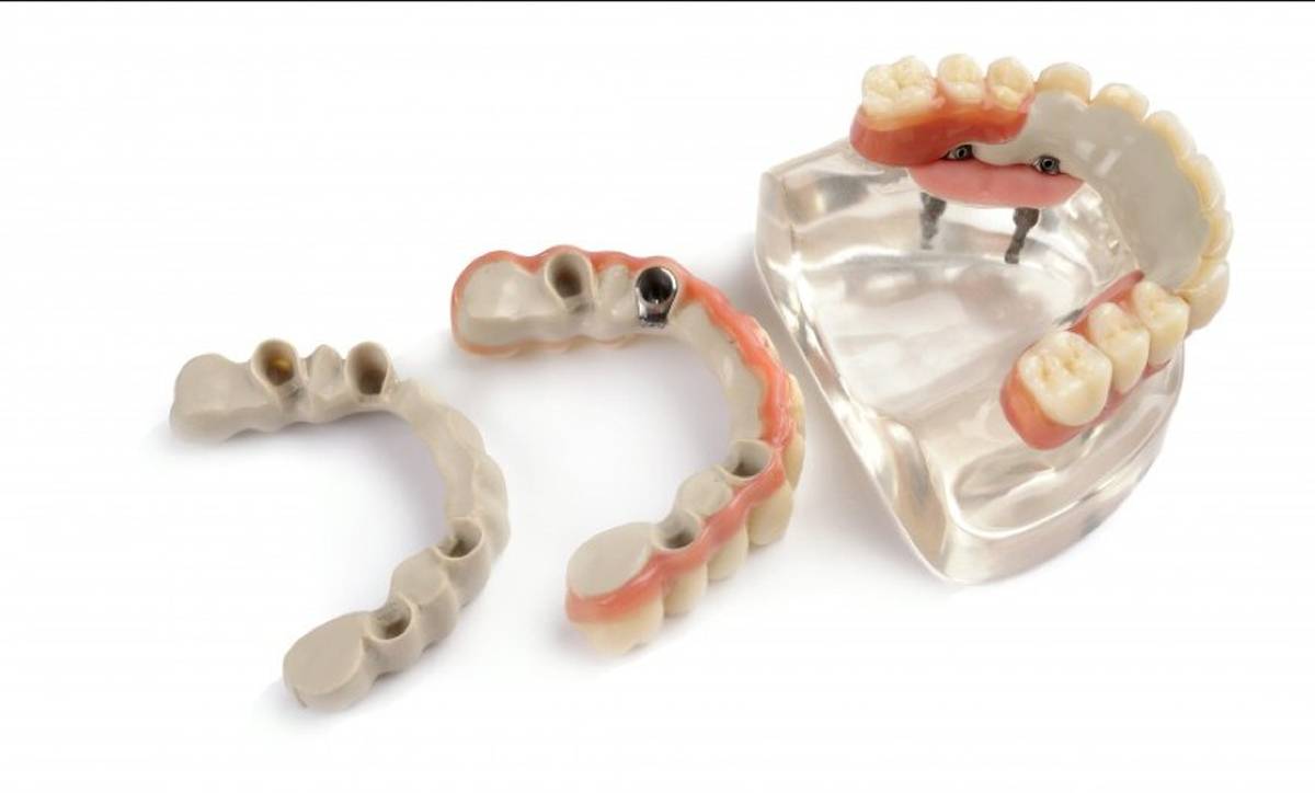Lo último en prótesis híbridas dentales: fabricadas con peek