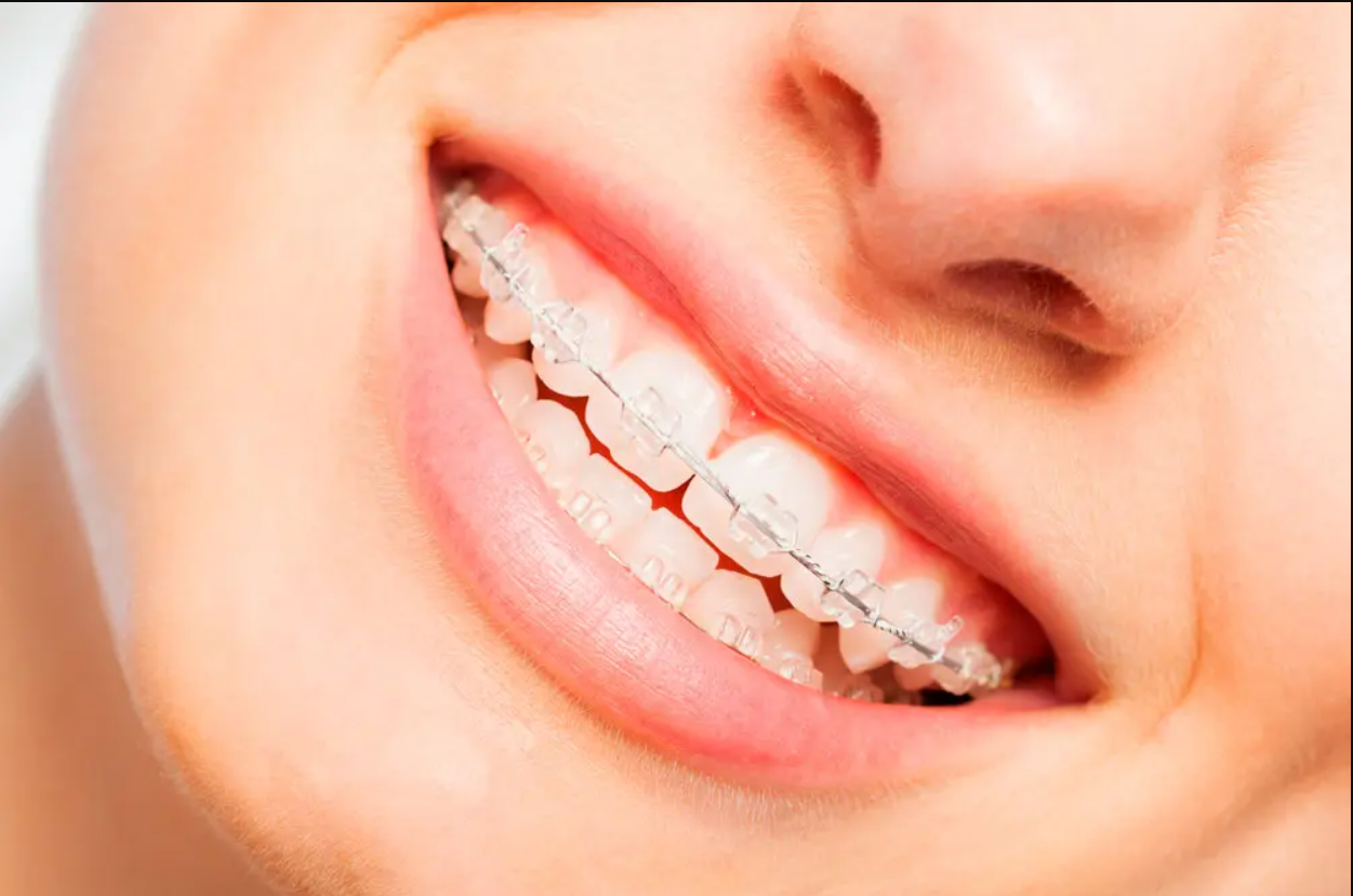 ¡Sonríe con Confianza con los Brackets de la Clínica Dental Dra. Cuadrado!